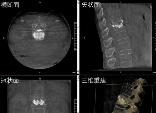 三維C形臂與二維C形臂臨床圖像實時對比