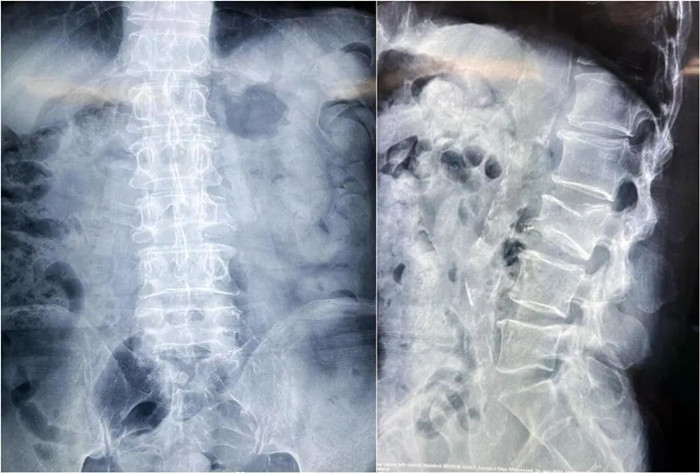 大平板C臂機-術(shù)前影像 大平板C臂機-術(shù)前影像
