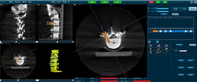 脊柱微創(chuàng)手術(shù)機器人-定位準確