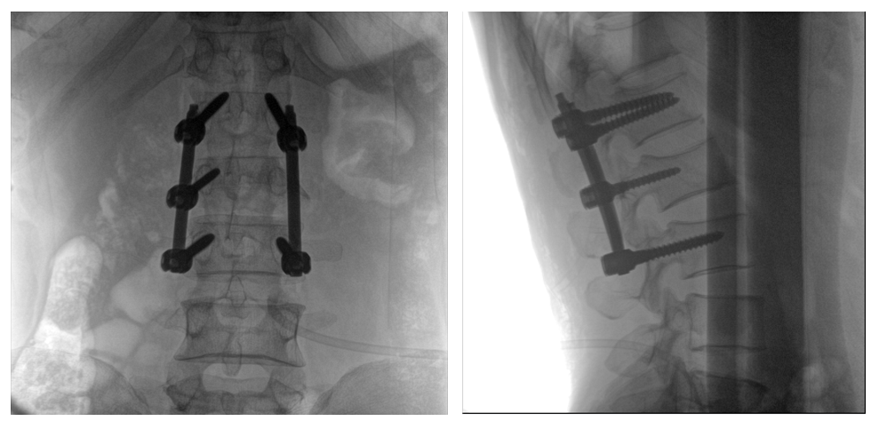 移動(dòng)式一體化C形臂全節(jié)段腰椎臨床影像