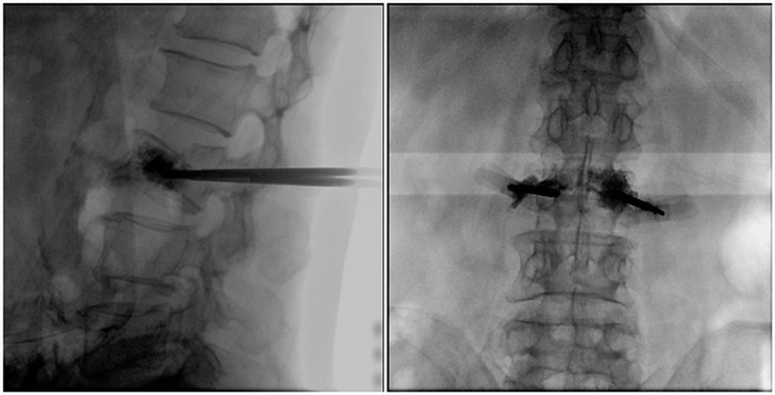 一體式移動C臂腰椎影像 一體式移動C臂腰椎影像