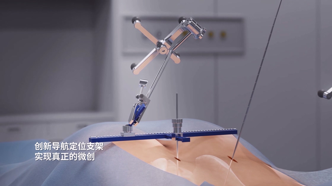 骨科手術(shù)機(jī)器人導(dǎo)航定位支架